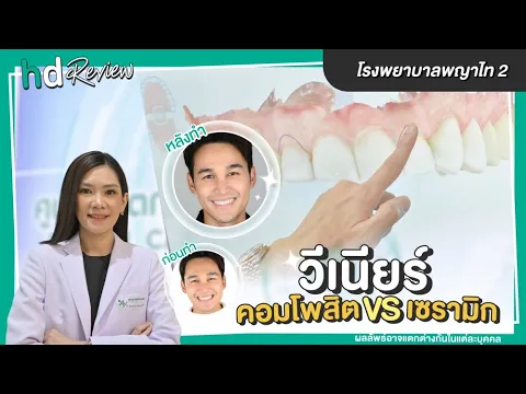 คอมโพสิตวีเนียร์ Vs เซรามิกวีเนียร์ ต่างกันยังไง? รีวิวนี้มีคำตอบ! รีวิวทำวีเนียร์ที่ รพ. พญาไท 2