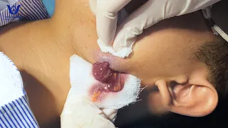 Điều trị mụn nhọt áp xe vùng quai hàm - Tại phòng khám da liễu HHV Clinic.