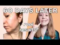 Angel Lift 60 Day Results Laugh Line Experiment Nurse Review No Botox