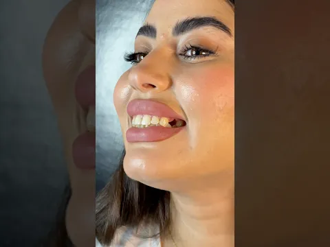 زراعة سن مفقود ✨ بخطوات واضحة و بسيطة، شاهدوا الفيديو 💫 #اكسبلور #dentist #implants
