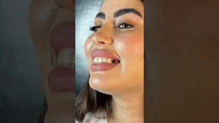 زراعة سن مفقود   بخطوات واضحة و بسيطة  شاهدوا الفيديو    اكسبلور                    دندنها