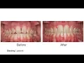 Yang Orthodontics - Patient Testimonial after Braces