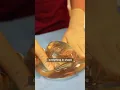 Will a silicone implant leak into your body if it ruptures