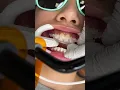 Download Lagu How Braces are Put On