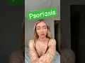 What Is Psoriasis