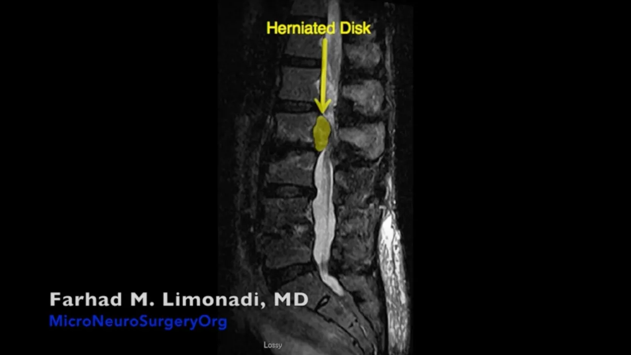 Step wise exercises for disc bulge and herniated disc Recovery L4-L5, L5-S1. In this video Dr. Varun. 