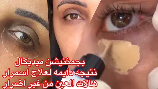 تقنيه الكاموفلاج لتفتيح هالات والاسمرار العين نتيجه دايمه ومن غير اضرار  كاموفلاج دندنها