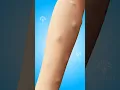 Download Lagu Why Do Lipomas Form Under Your Skin #shorts #viralvideo #lipomas - Creativelearning3d