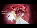 Philips IVUS in peripheral arterial disease PAD