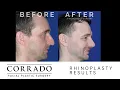 Rhinoplasty Patient Experience Dr Anthony Corrado