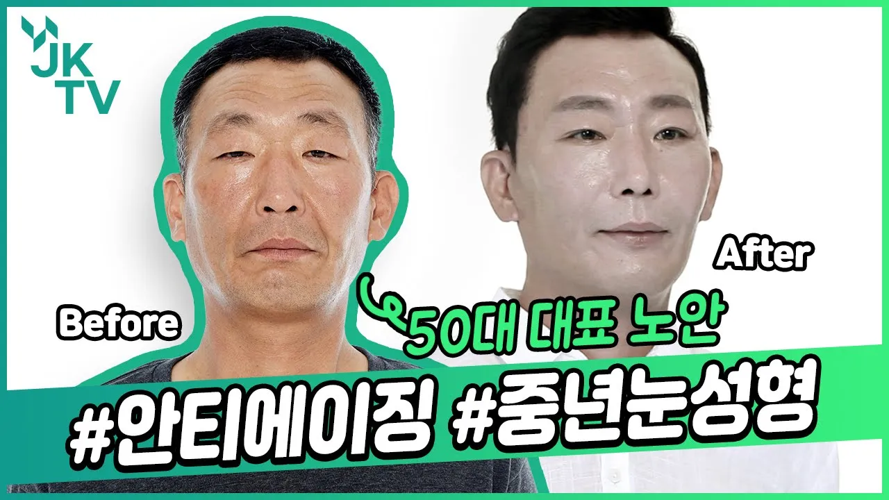 🌟50대 남자성형🌟 눈성형❔❕ 리프팅❔❕ 티 안나게 체인지🌠