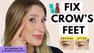 treatments for crows feet that work fix eye wrinkles dr sam ellis
