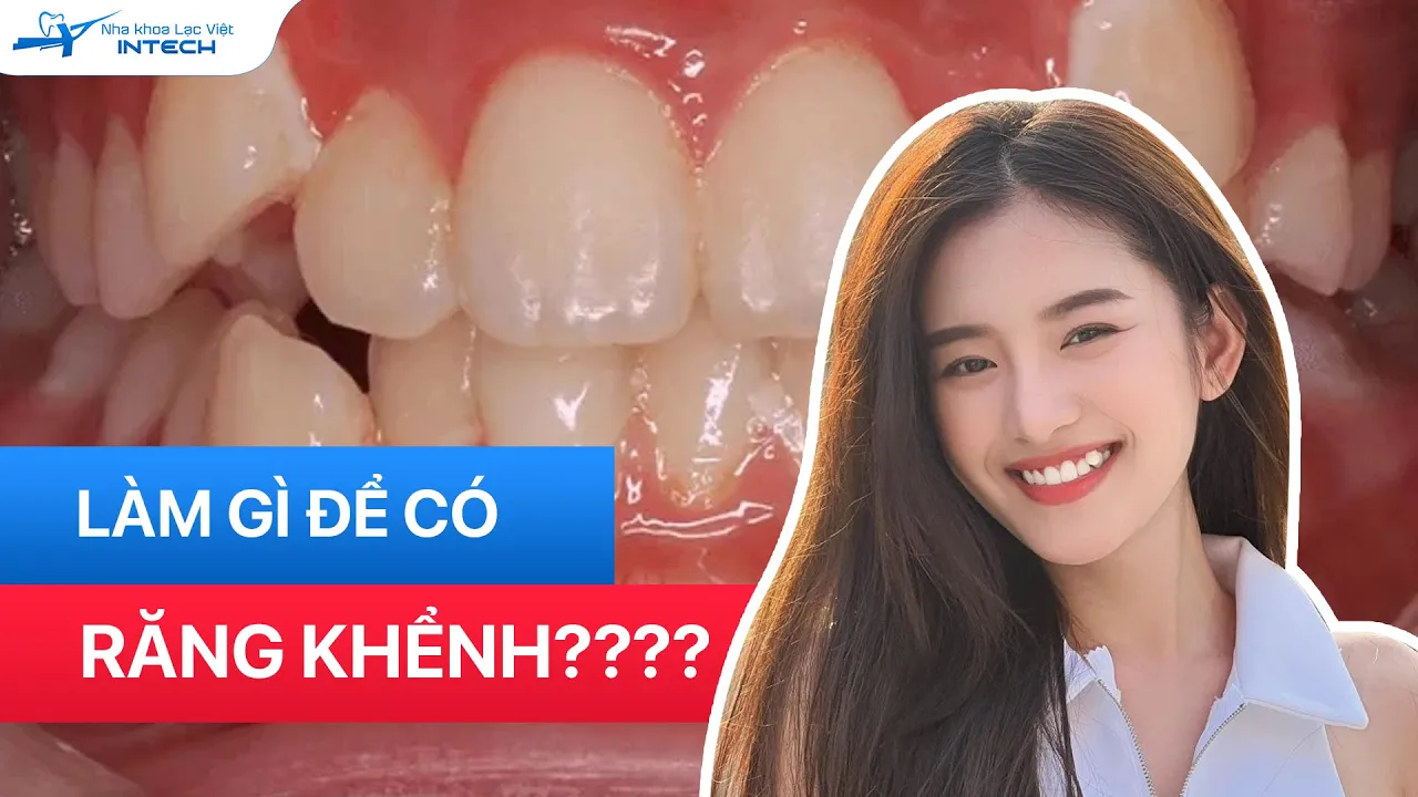 Outline Video Làm Răng Khểnh: Có Cách Nào Làm Răng Khểnh? Làm Răng Khểnh Mất Bao Nhiêu Tiền?