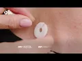 Compound W Nitro Freeze Skin Tag Remover step-by-step how-to