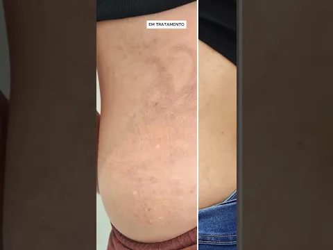 Antes e Depois Finalizado! Adeus Fadinha🧚‍♀️✨| Remoção de Tatuagem
