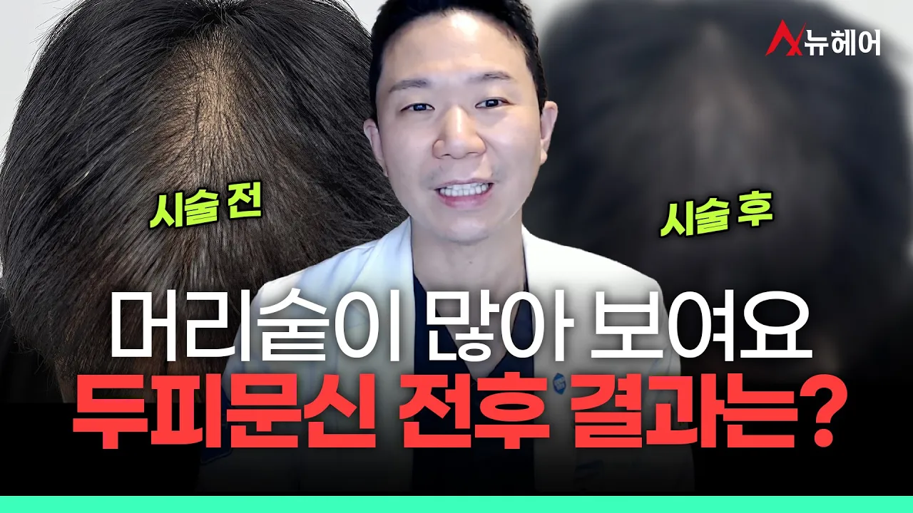 머리숱이 많아 보이는 두피문신 전후 효과는?ㅣ뉴헤어