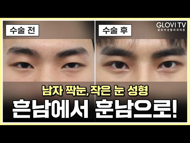 남자 눈 성형 고민이라면 꼭 보세요! | 쌍수, 눈매교정 리얼 후기