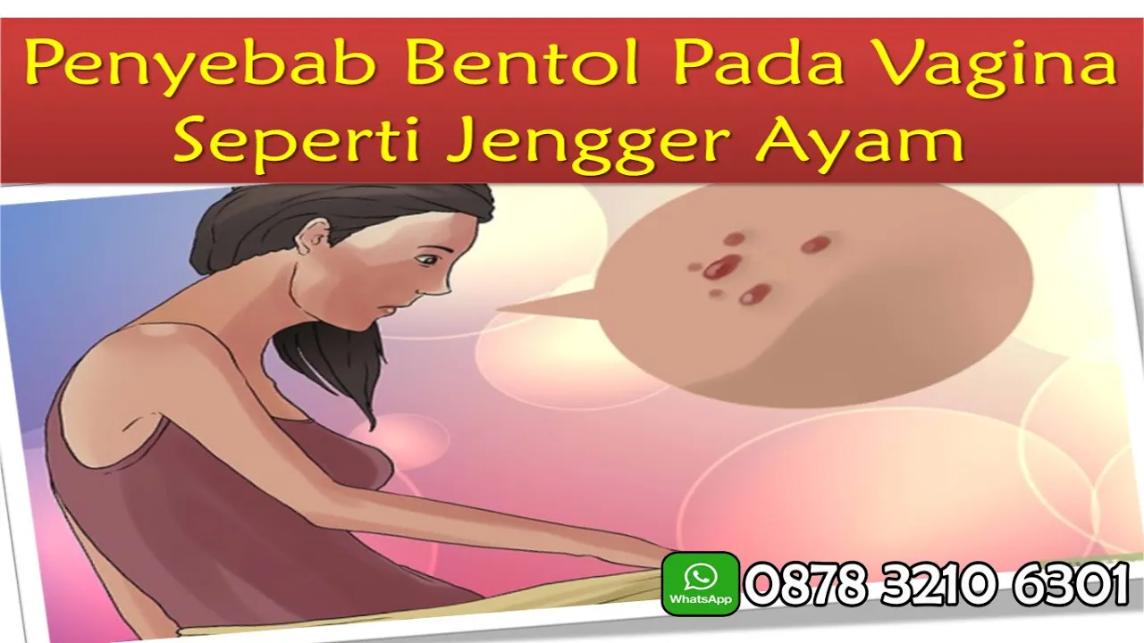 Penyakit Jengger Ayam pada Wanita - Obat Kutil Kelamin Herbal