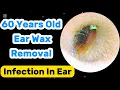 Download Lagu 60 Years Old Ear Wax Removal | Infected Ear Canal | Satisfaction | Asmr | Ear Cleaning 