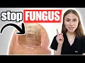 How to Treat and Prevent Toenail Fungus at Home Step-by-Step