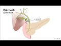 ERCP-4a Bile Duct - Leak