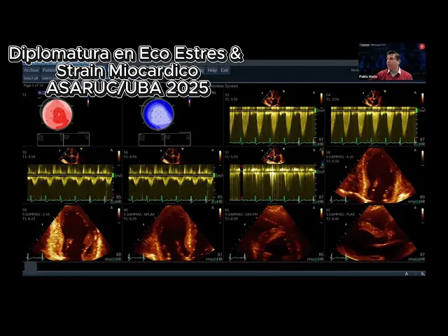 Practico en vivo con EchoPAC - Eco estres y strain miocardico