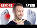 Download Lagu How to Fix Bunions Naturally [No Surgery Needed]