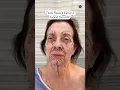 Natural Results Facelift 2 Months Post-Op Before and After