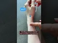 Lagu 📍Needling LU 7 Acupuncture Point #acupuncturepoints