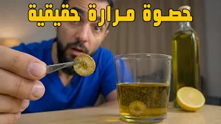 إذابة حصوة المرارة بدون جراحة..جرّبت أشهر وصفة إذابة على حصوتي 24 ساعة… شاهد النتيجة!