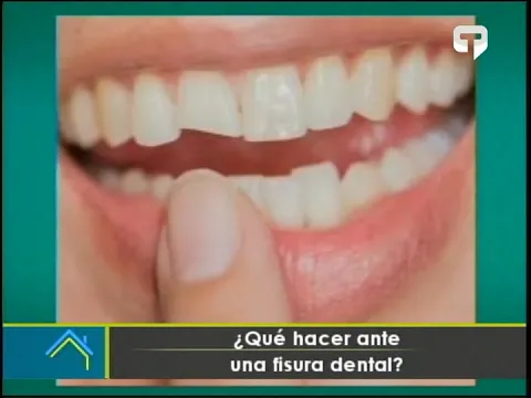 ¿Qué hacer ante una fisura dental?