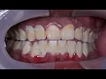Download Lagu 1 min edition: Scaling video | Dentist | Dokter Gigi Tri Putra