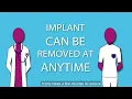 NHS Contraceptive Implant Information