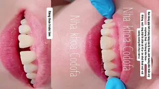 Đóng khe thưa - không mài răng ăn nhai thoải mái ạ  