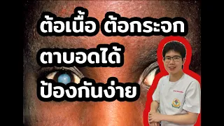 สาเหตุหลักที่ทำให้เกิดต้อเนื้อ ต้อลม และต้อกระจกมีอะไรบ้าง