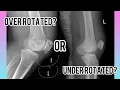 How to Fix a Lateral Knee
