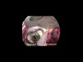 Download Lagu Mitral valve repair in RLM: severe MI, P1 prolapse ( with the ReChord system)