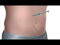 Introduction to Insulin Vial bottle Syringe Injections