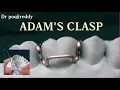 Download Lagu Adams clasp |Adams clasp fabrication |Dr poojireddy