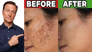 Download How to Get Rid of Hyperpigmentation (Aging or Dark Spots) MP3