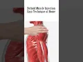 Download Lagu How to give an intramuscular (IM) Injection in deltoid muscle in shoulder easily at home