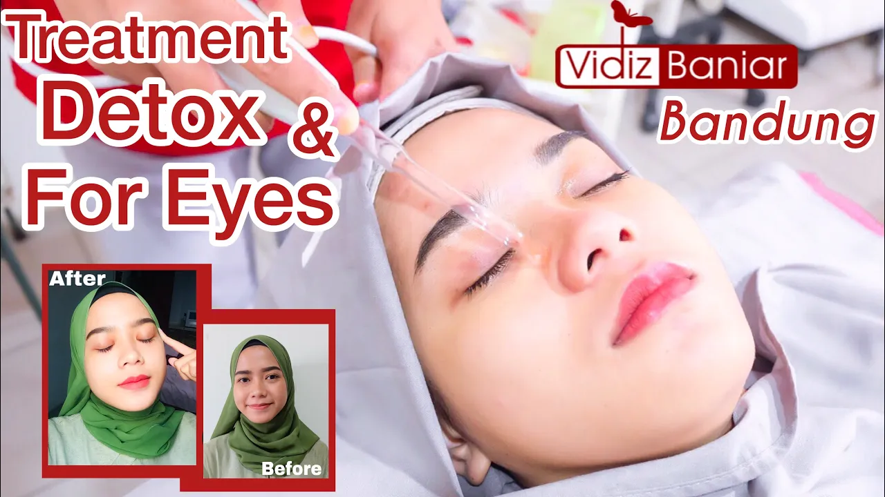 bopeng #caramengobatibopeng #creambopeng #treatmentbopeng #bopengbisasembuh Video ini merupakakan pe. 