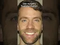 Download Lagu Before and after jaw surgery (insane change) #jawsurgery #orthodontist