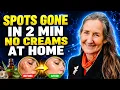 Age Spots Gone 5 Things Your Doctor Will NEVER Mention Barbara O Neill
