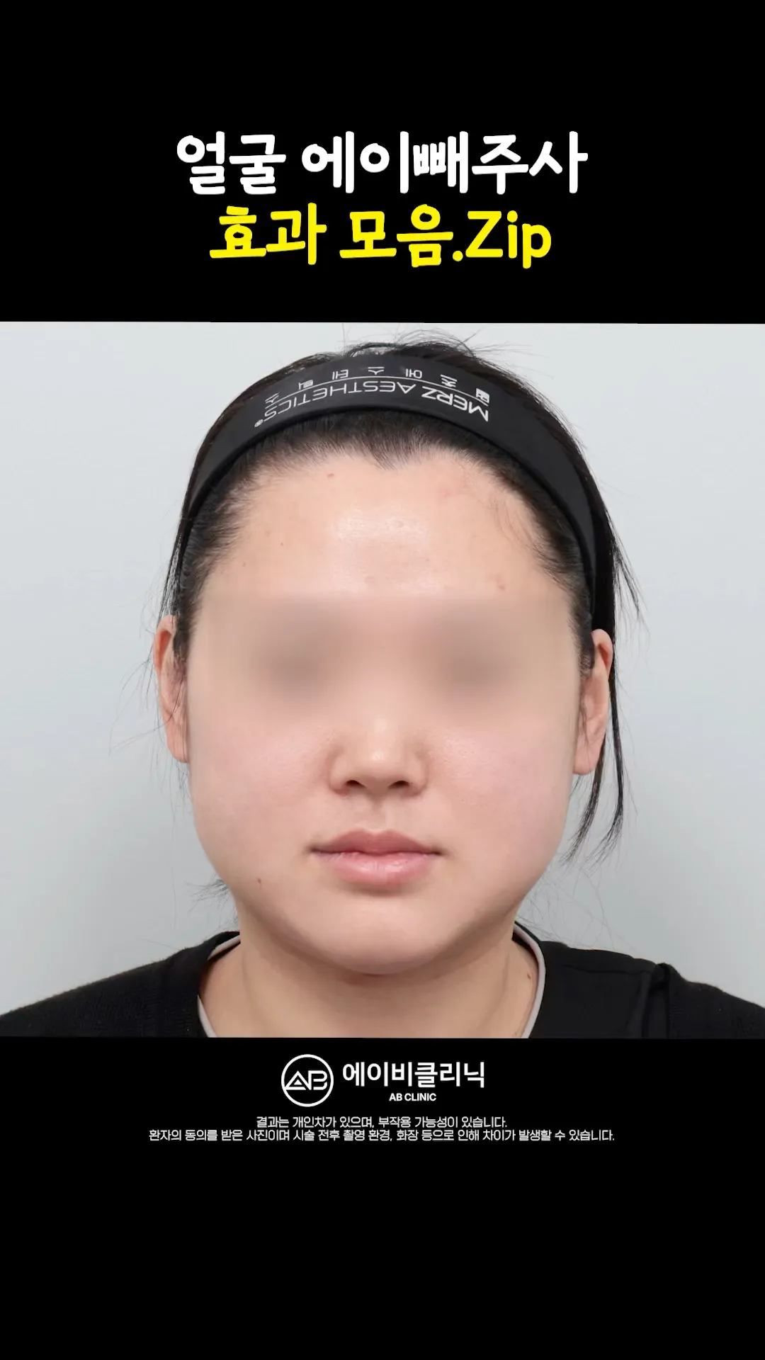 이중턱이랑 작별한 에이빼 전후 모음.ZIP