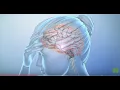 What Is a Migraine Headache