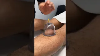 Foot Cupping For Runners 