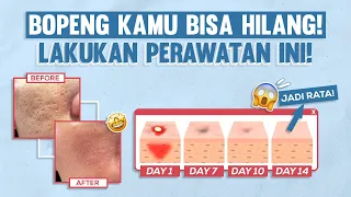 Download Bisa Mulus Lagi Perawatan Ini Bisa Menghilangkan Bopeng dan Bekas Jerawat Kamu! MP3