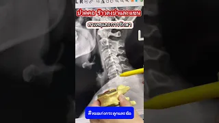  ทำไมถึงปวดคอ แล้วชาลงแขน 