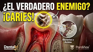 Caries dental: la verdad sobre cómo se forma realmente